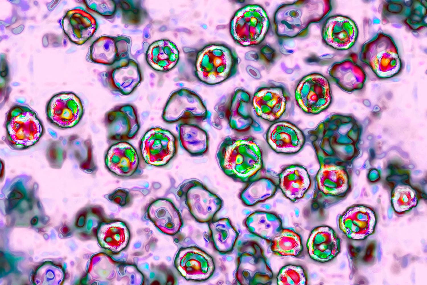 Sixth measles death reported in Pennsylvania amid outbreak